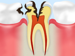 C2  中期の虫歯