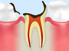 C3  後期の虫歯