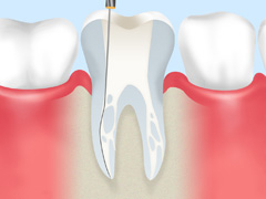 歯を保存するための治療～根管治療～
